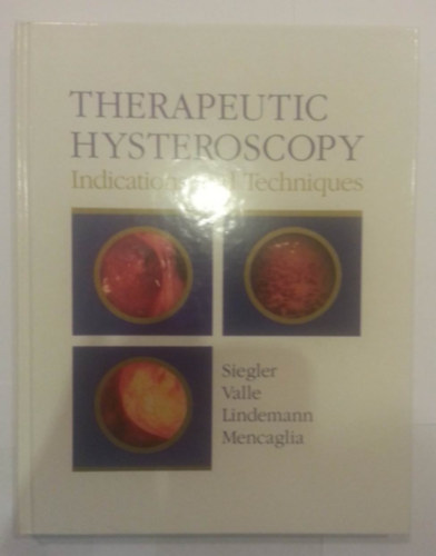 Alvin M. Siegler - Therapeutic Hysteroscopy: Indications and Techniques
